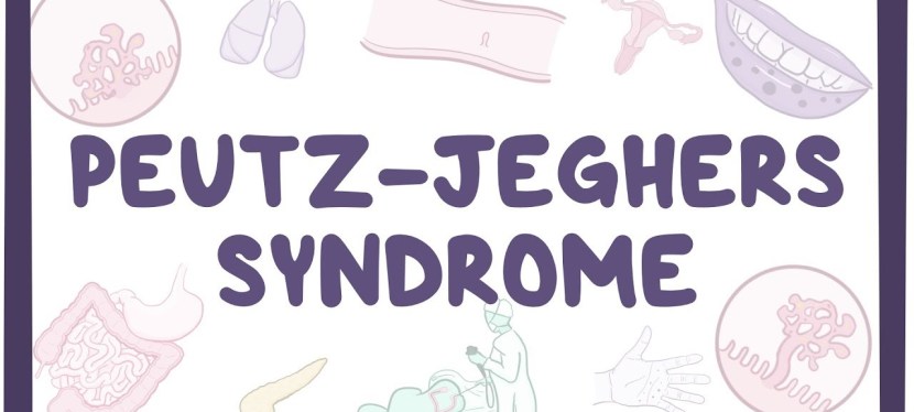 Sweeney’s Peutz-Jeghers Story – My Dance with&nbsp;Death